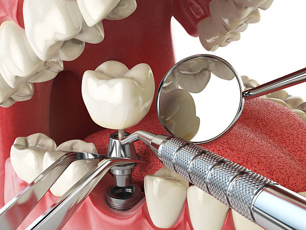 Best Emergency Tooth Extraction in Denton, NC